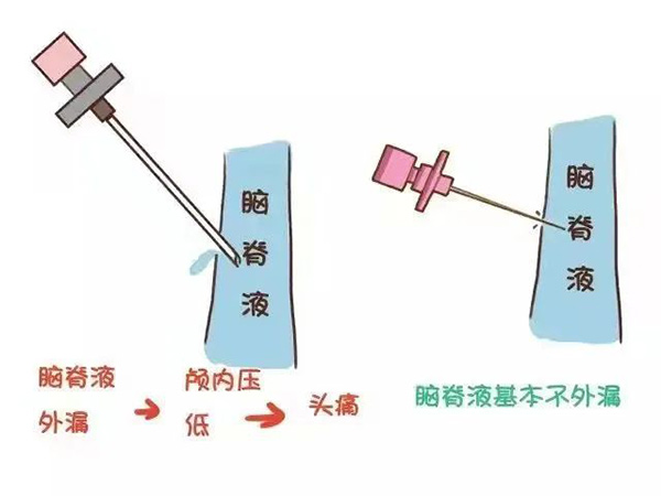 麻醉手術(shù)后不需要去枕平臥了 你知道嗎？