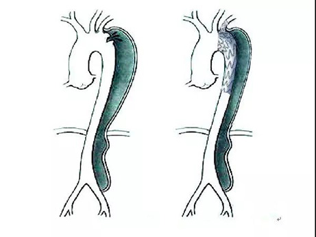 【特別關注】我院成功完成主動脈夾層腔內修復術一例，填補遼西空白
