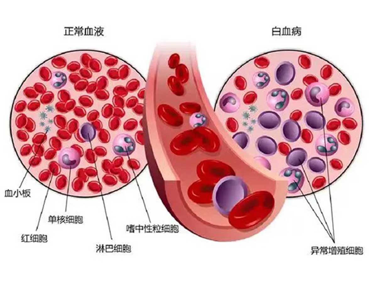 優(yōu)勢(shì)學(xué)科｜多學(xué)科合作 個(gè)體化治療 為老年高危急性髓系白血病合并壞疽性膿皮病患者帶來希望