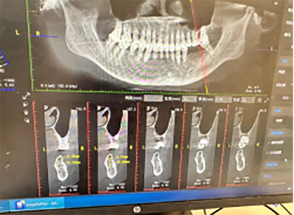優(yōu)勢技術(shù) | 骨增量技術(shù) 擴(kuò)大種植牙修復(fù)適應(yīng)證 提高手術(shù)成功率